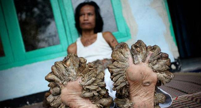 Indonesian known as 'tree man' dies due to rare disease